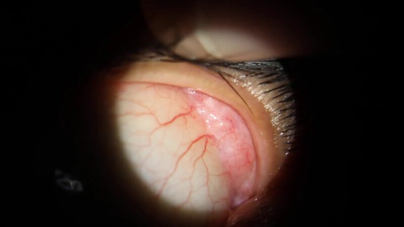 Dacryoadenitis Swollen Lacrimal Tear Gland