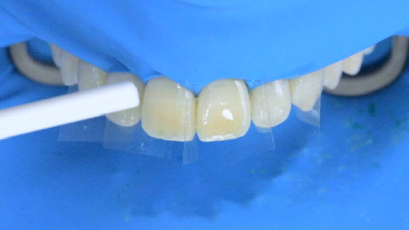 Fluorosis treatment using Icon infiltration