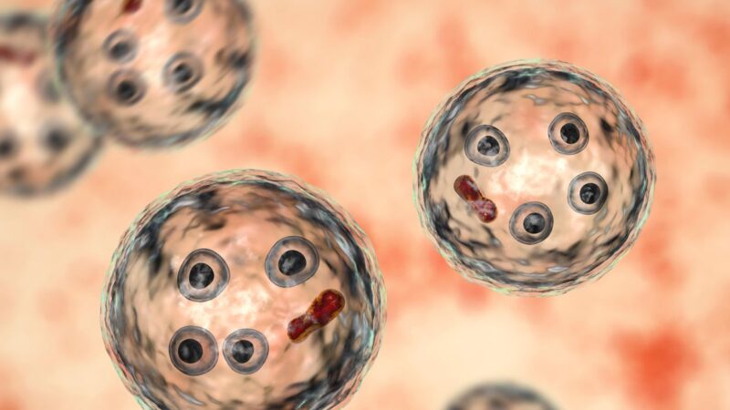 amebiasis