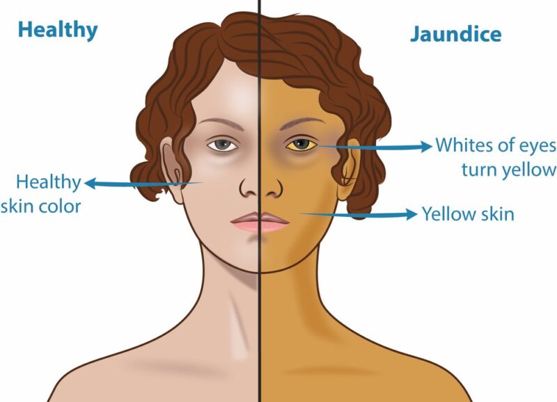 yellowish skin tone