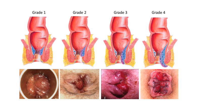 haemorrhoids and anal fissures